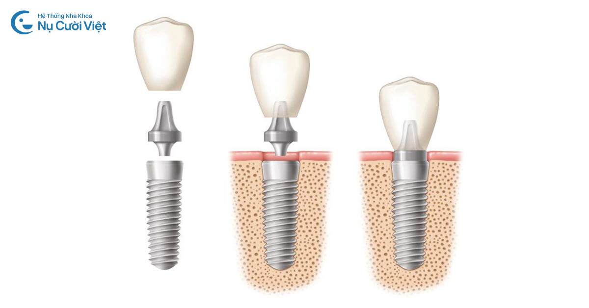 phục hình răng sứ trên implant là gì