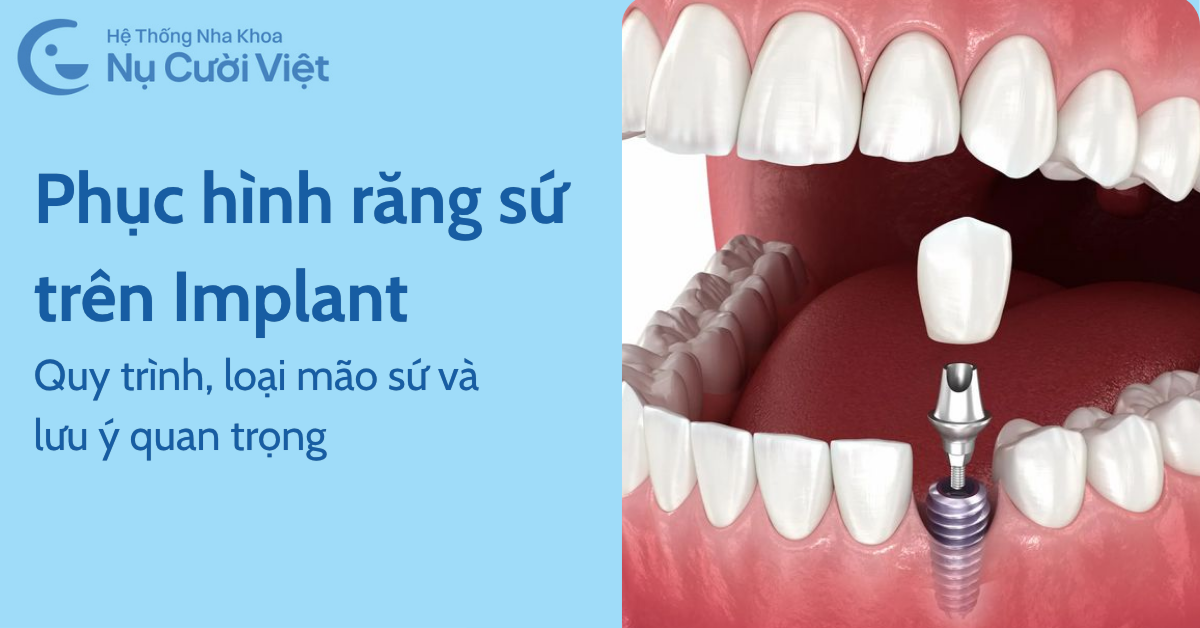 thế nào là phục hình răng sứ trên implant