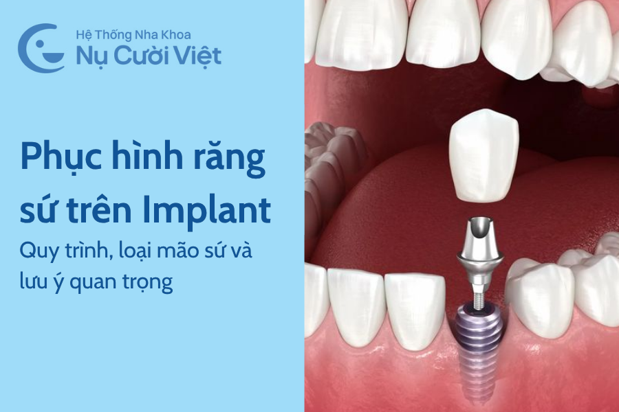 Nụ Cười Việt - Phục Hình Răng Sứ Trên Implant: Quy Trình, Loại Mão Sứ Và Lưu Ý Quan Trọng