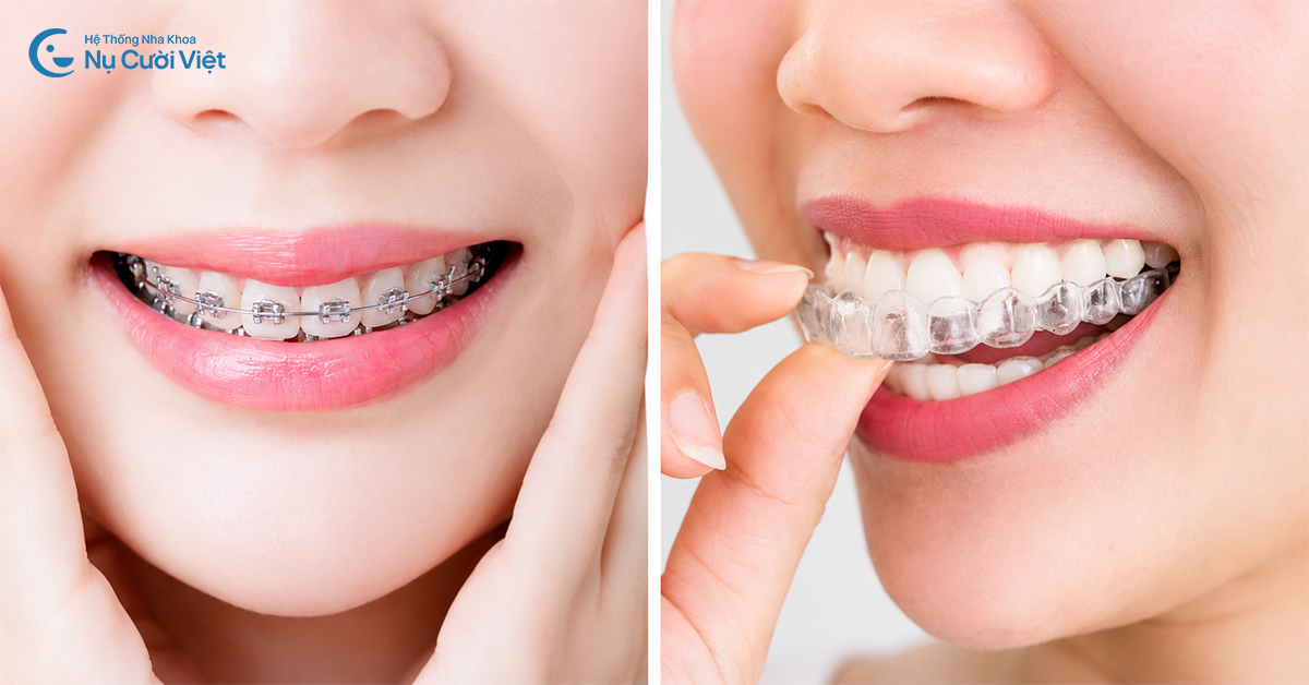 niềng răng khắc phục khớp cắn chuẩn