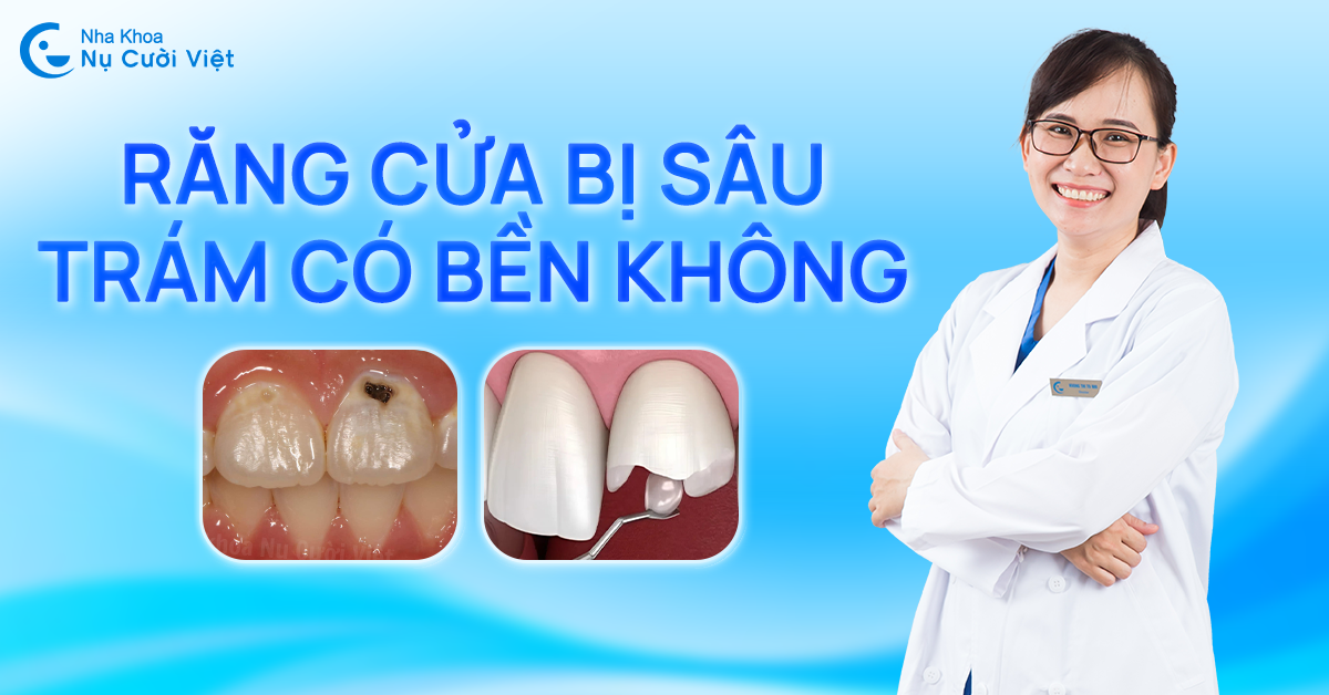 răng cửa bị sâu trám lại có bền không
