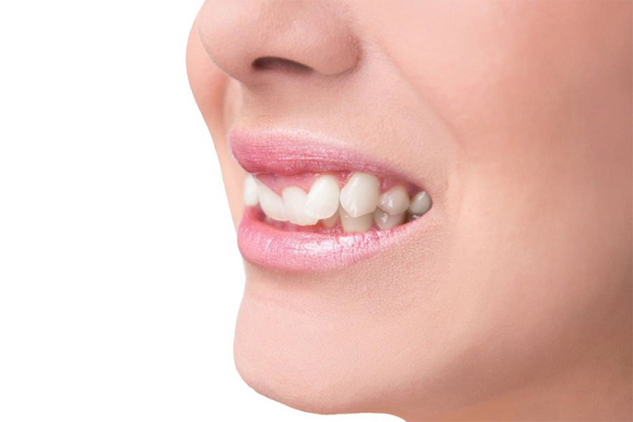 Nụ Cười Việt - RĂNG KHẤP KHỂNH CÓ DÁN SỨ VENEER ĐƯỢC KHÔNG?