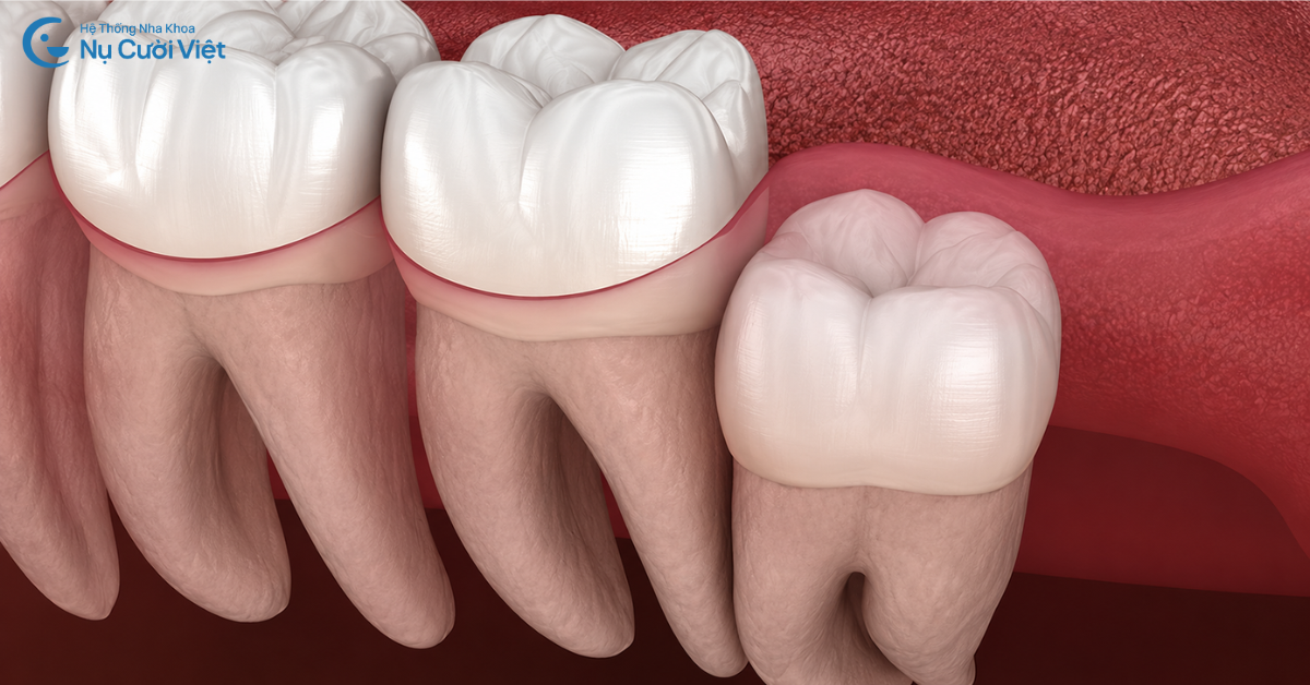 răng hôn mọc thẳng cần nhổ không