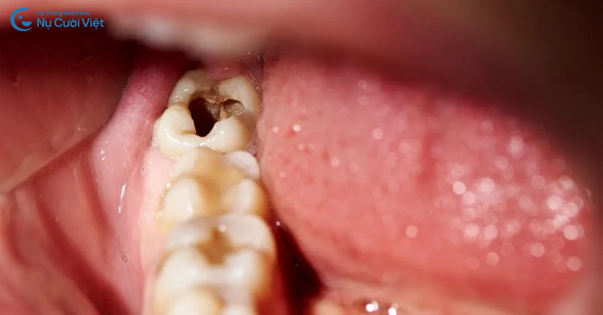 trường hợp răng khôn mọc thẳng cần nhổ