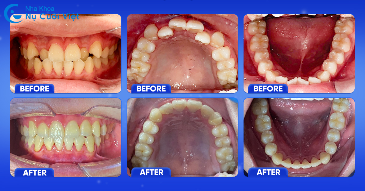 niềng răng trong suốt khắc phục răng lộn xộn
