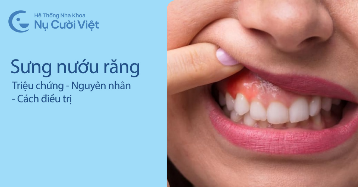 sưng nướu răng là gì, triệu chứng, nguyên nhân