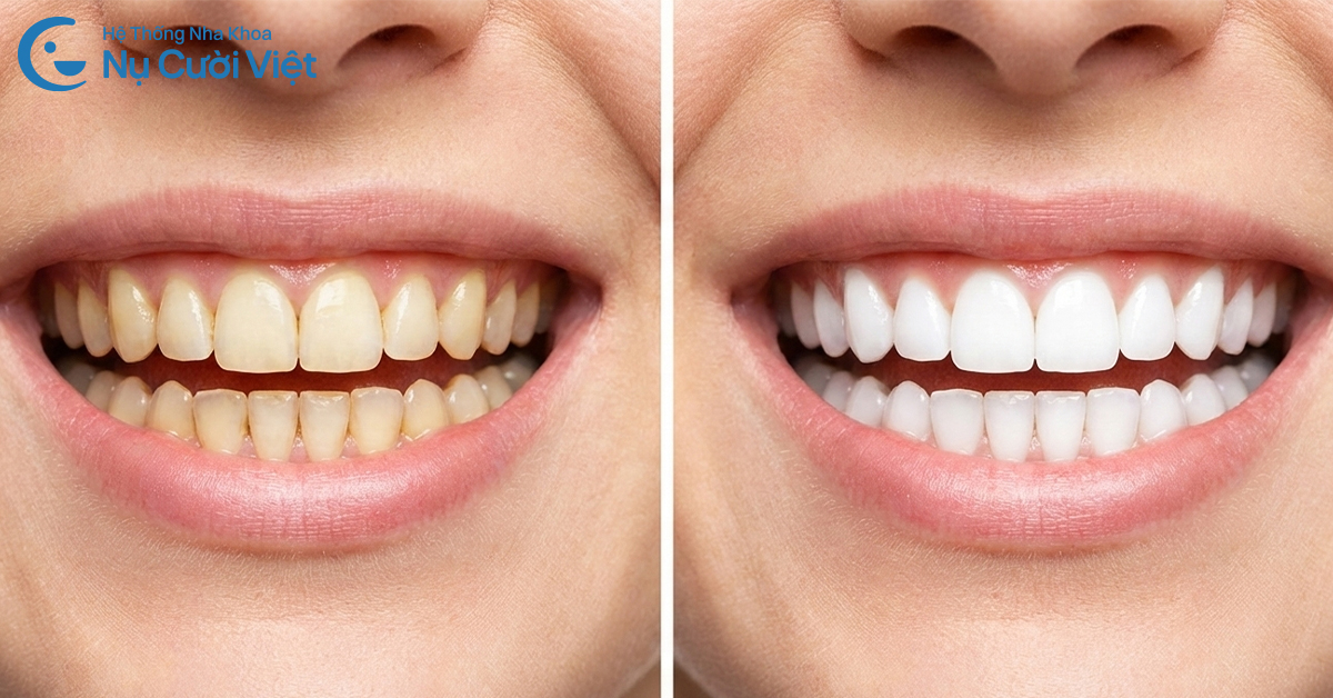 tẩy trắng răng có làm hại men răng không