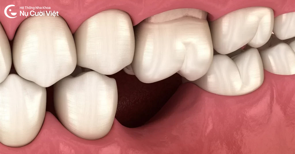 tiêu xương hàm có được trồng implant không