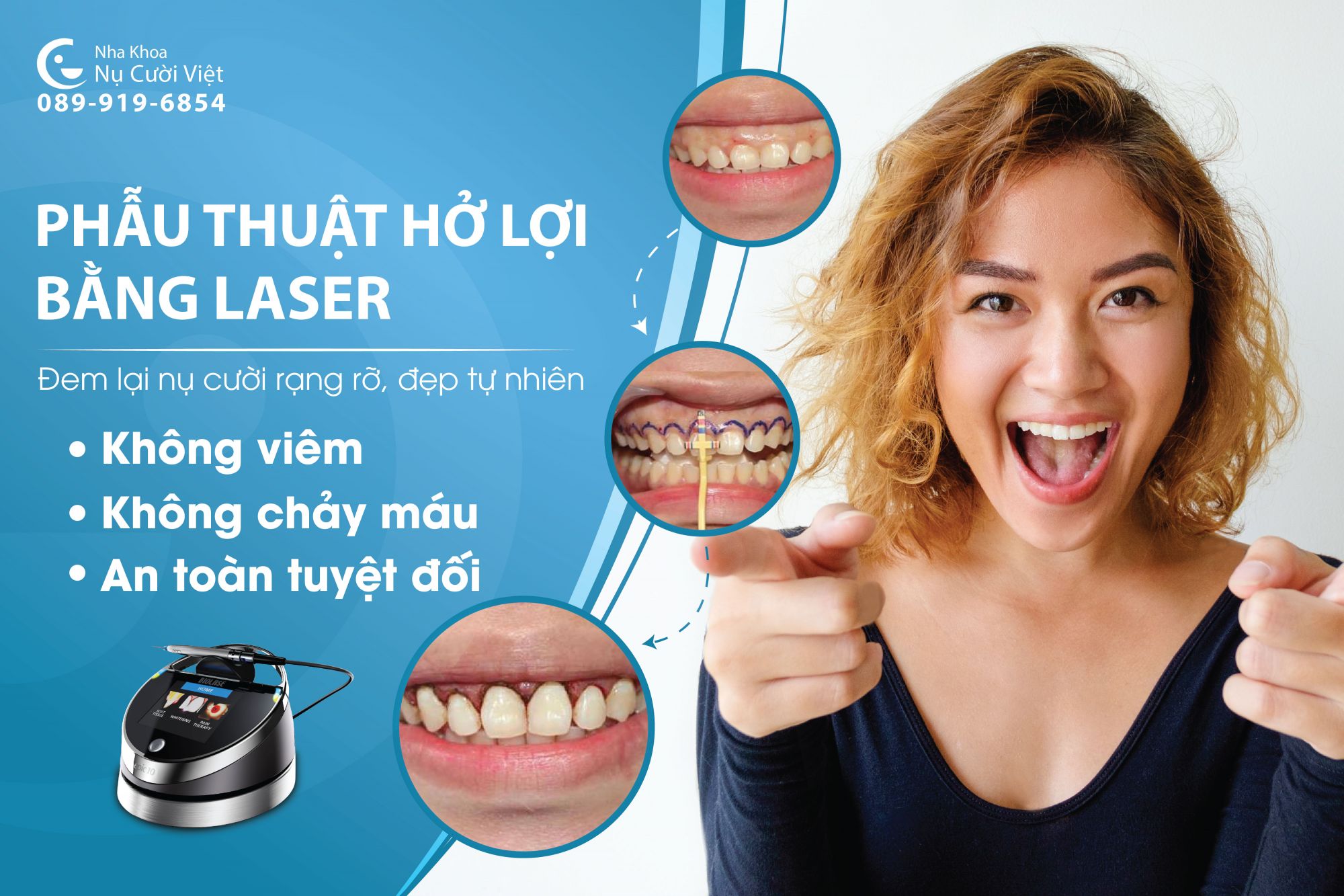 phẫu thuật cắt nướu bằng công nghệ laser 3.0