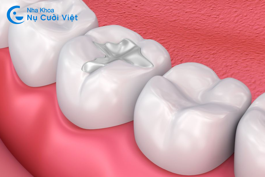 Nụ Cười Việt - Trám răng