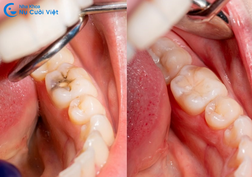 trám răng sữa là gì