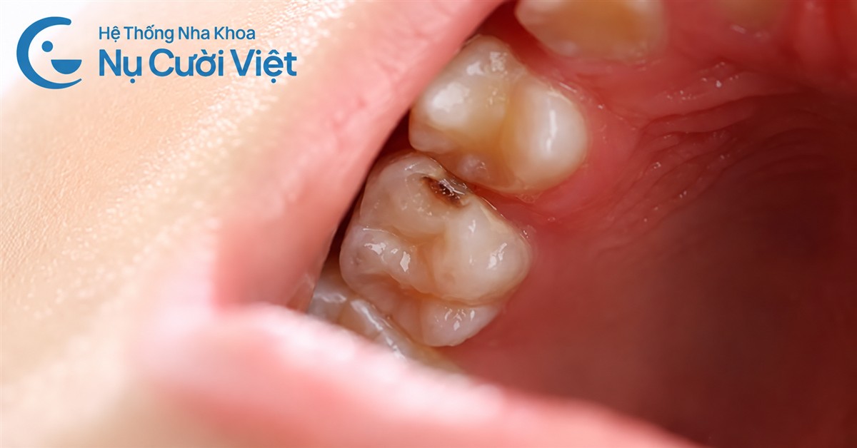 trẻ bị sâu kẽ răng
