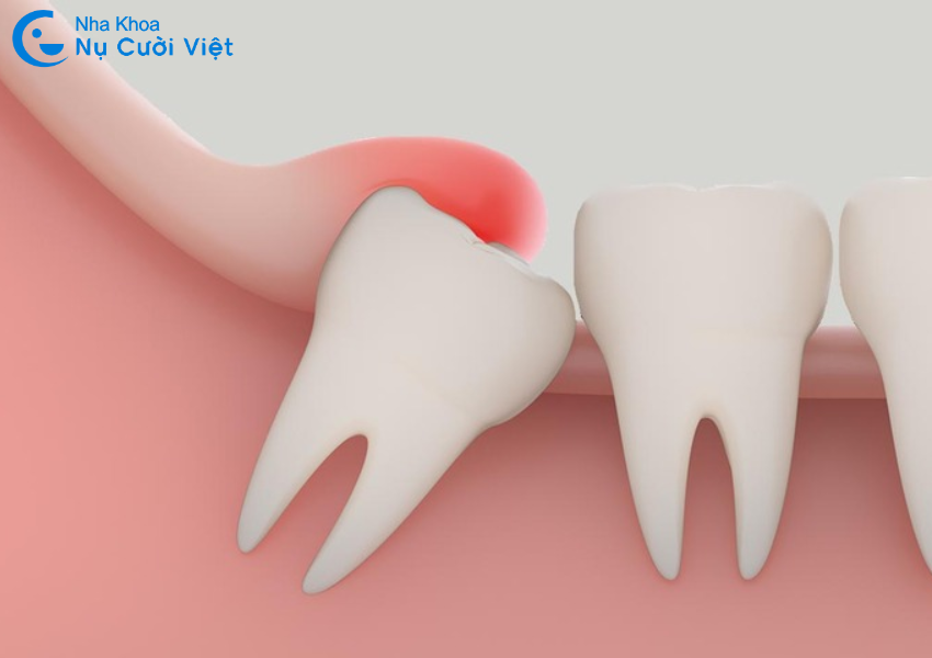 Nụ Cười Việt - 6 triệu chứng mọc răng khôn dễ nhận biết nhất