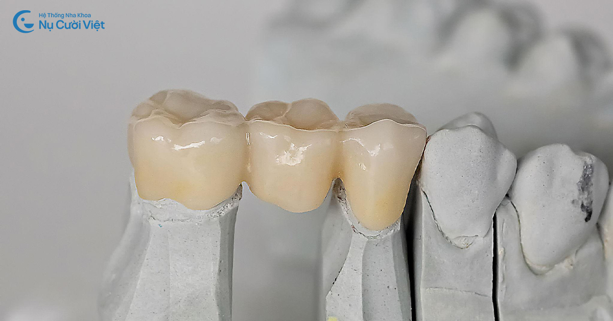 trồng 1 răng bằng cầu răng sứ