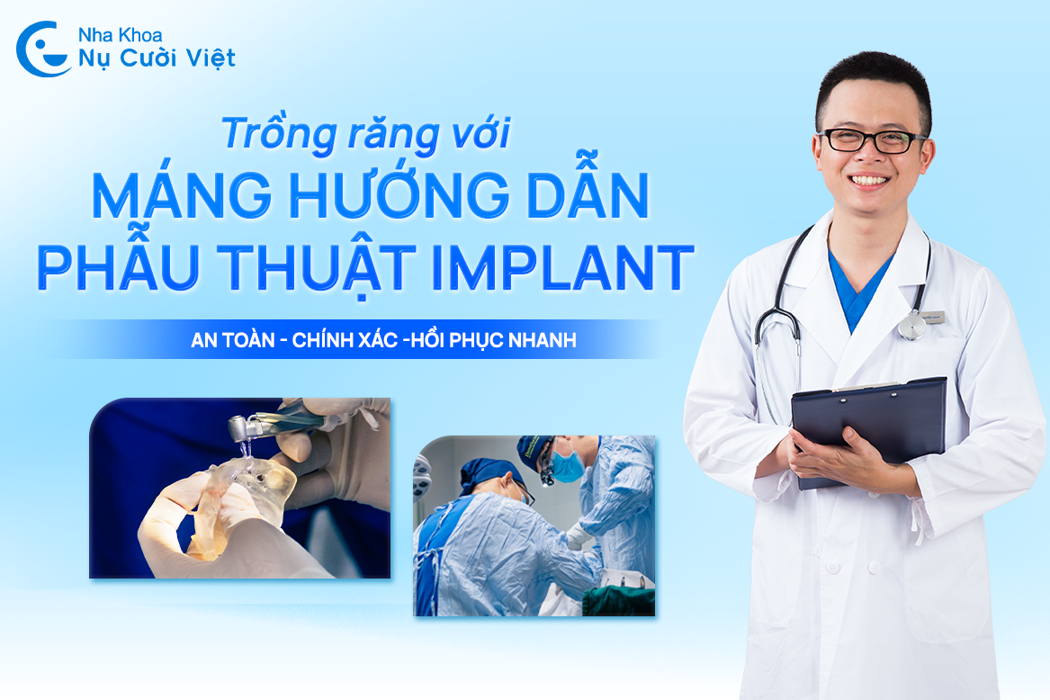 Nụ Cười Việt - Trồng răng với máng hướng dẫn phẫu thuật Implant - An toàn, chính xác, hồi phục nhanh