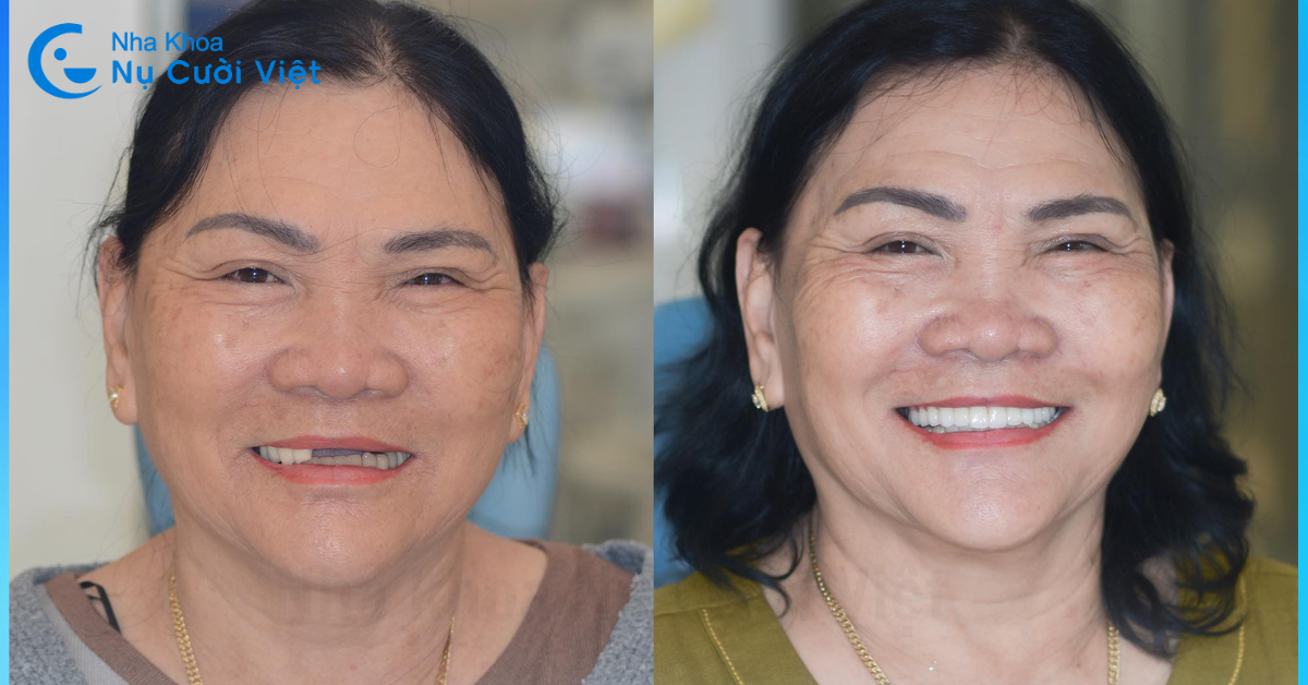 Nụ Cười Việt - NGƯỜI GIÀ MẤT RĂNG NÊN CHỌN: TRỒNG IMPLANT, CẦU RĂNG SỨ HAY HÀM GIẢ THÁO LẮP
