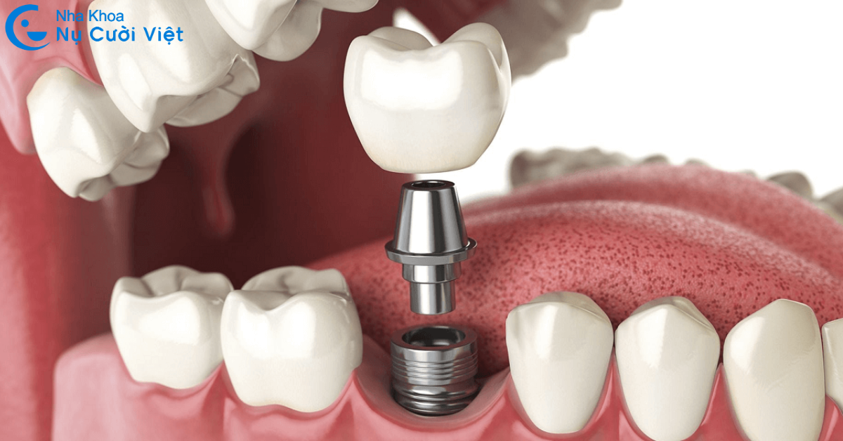 trồng răng implant răng số 6