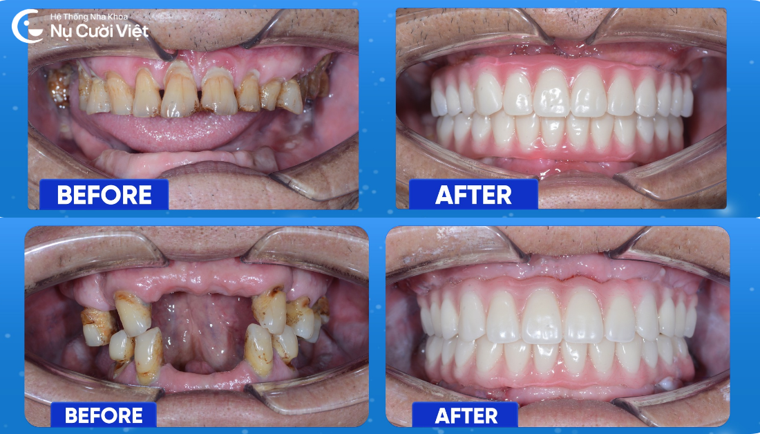 trồng răng implant toàn hàm có đau hay không