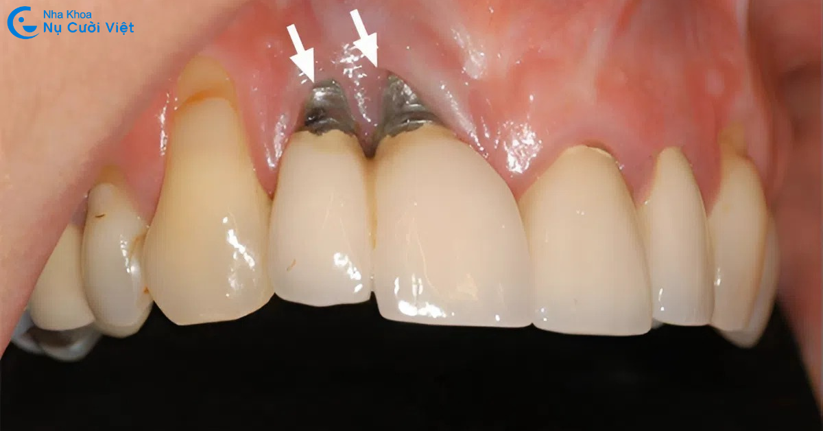 trụ implant bì đào thải