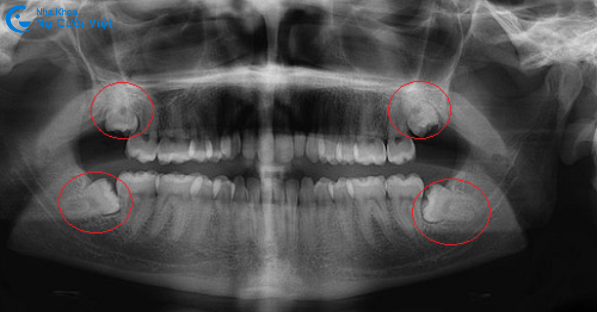 trường hợp cần nhổ răng khôn khi niềng răng