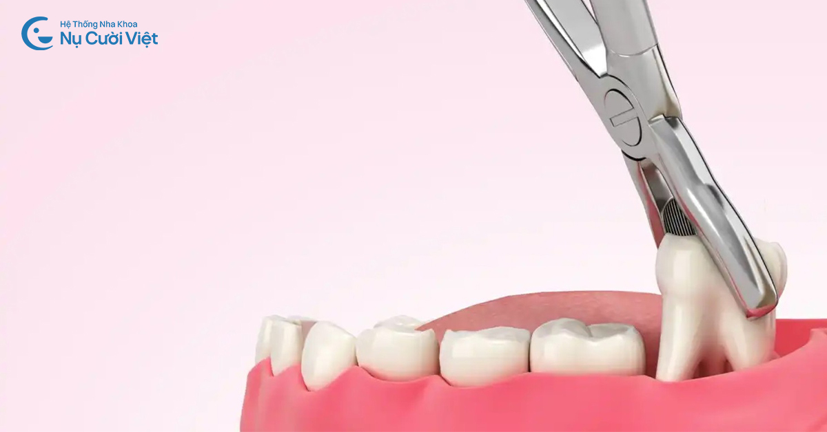trường hợp được nhổ răng khôn khi bị sưng lợi