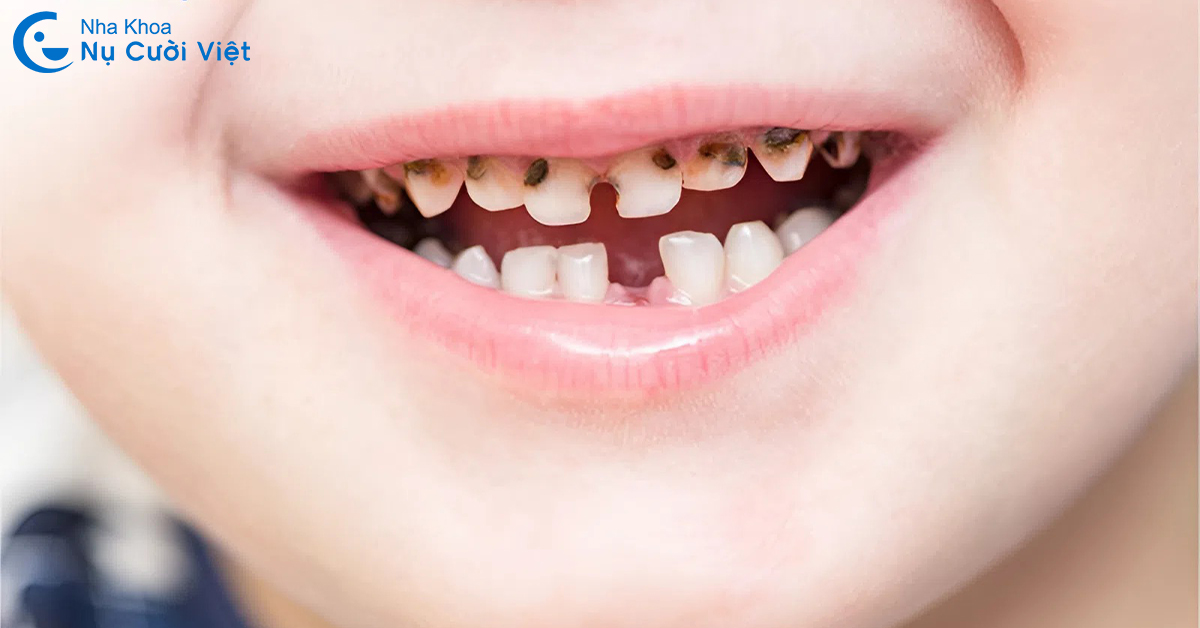 những trường hợp nên chụp thép răng sữa cho trẻ