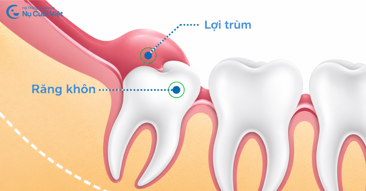 trường hợp răng khôn mọc thẳng không cần nhổ