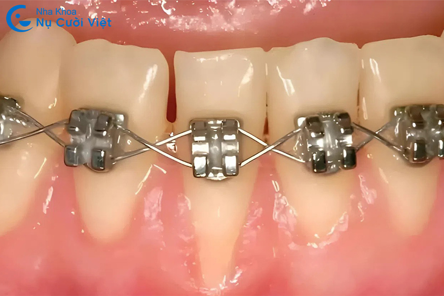Nụ Cười Việt - Tụt lợi khi niềng răng có nguy hiểm không? 