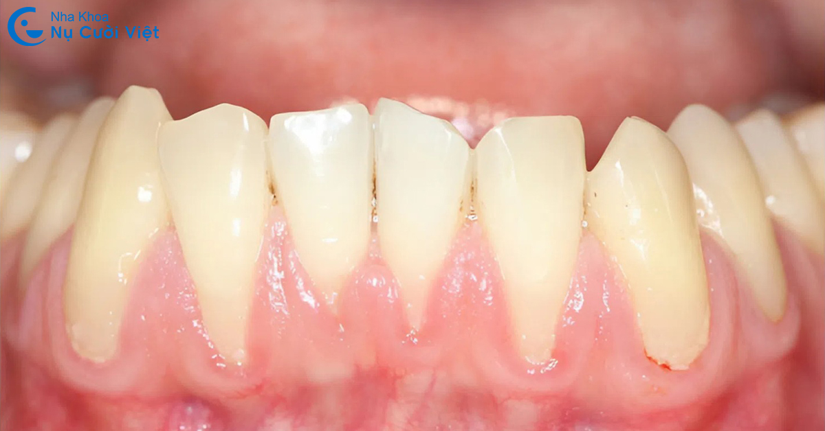 tụt lợi khi niềng răng là gì