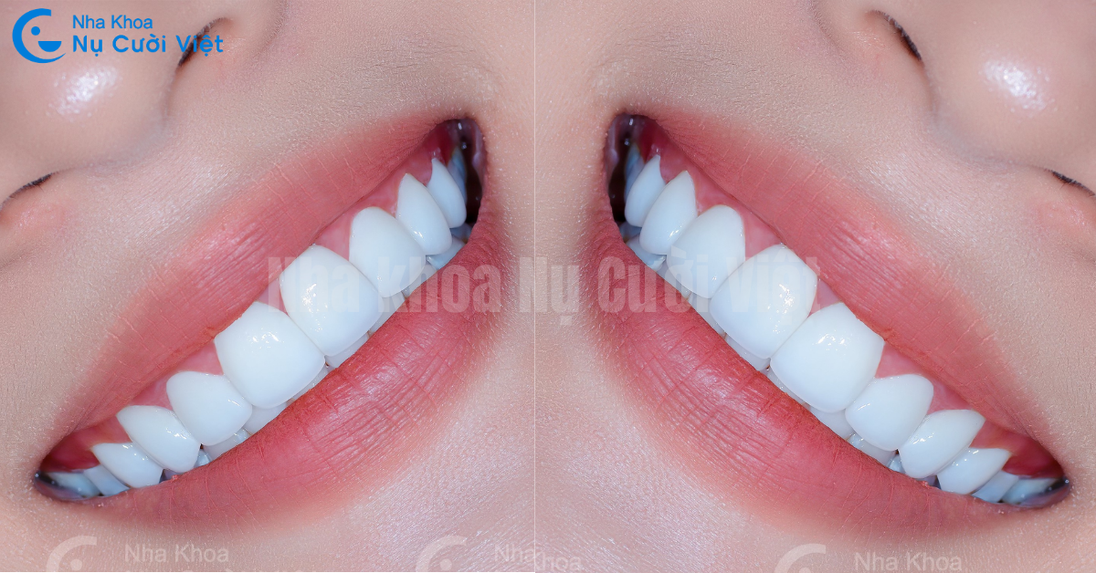 ưu điểm của mặt dán sứ veneer