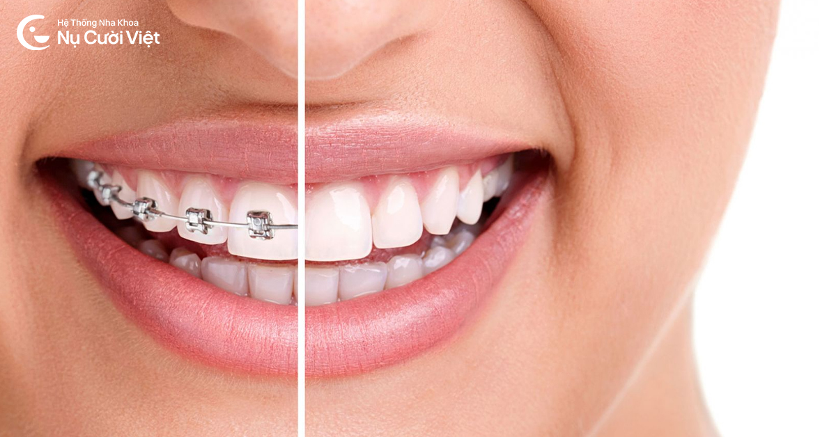 ưu điểm niểng răng trước khi bọc sứ